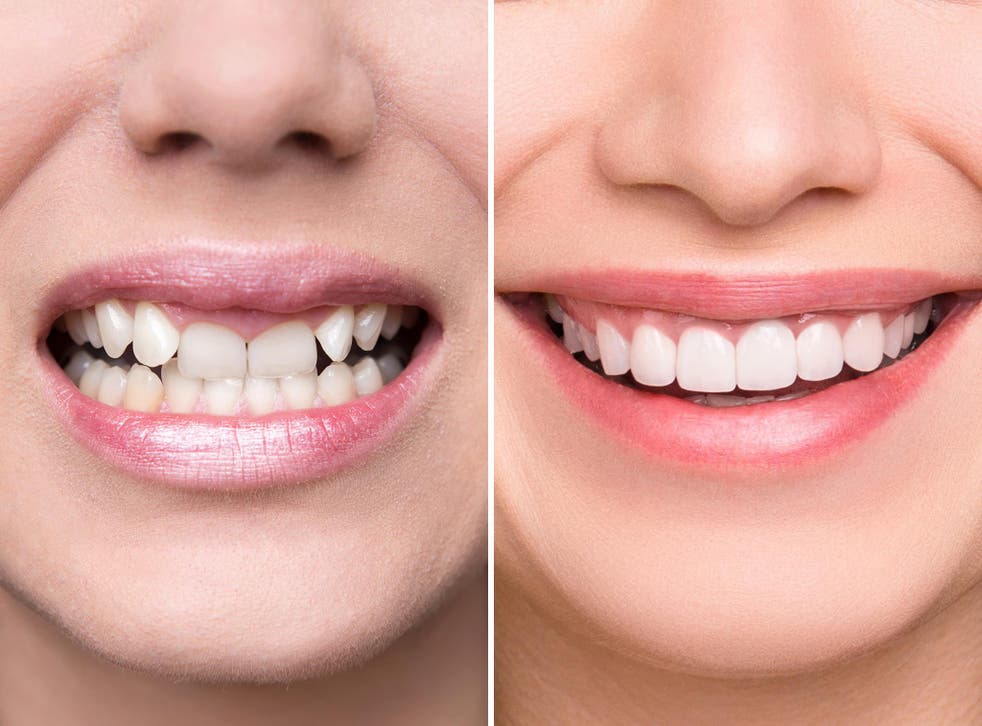 before after dental treatment