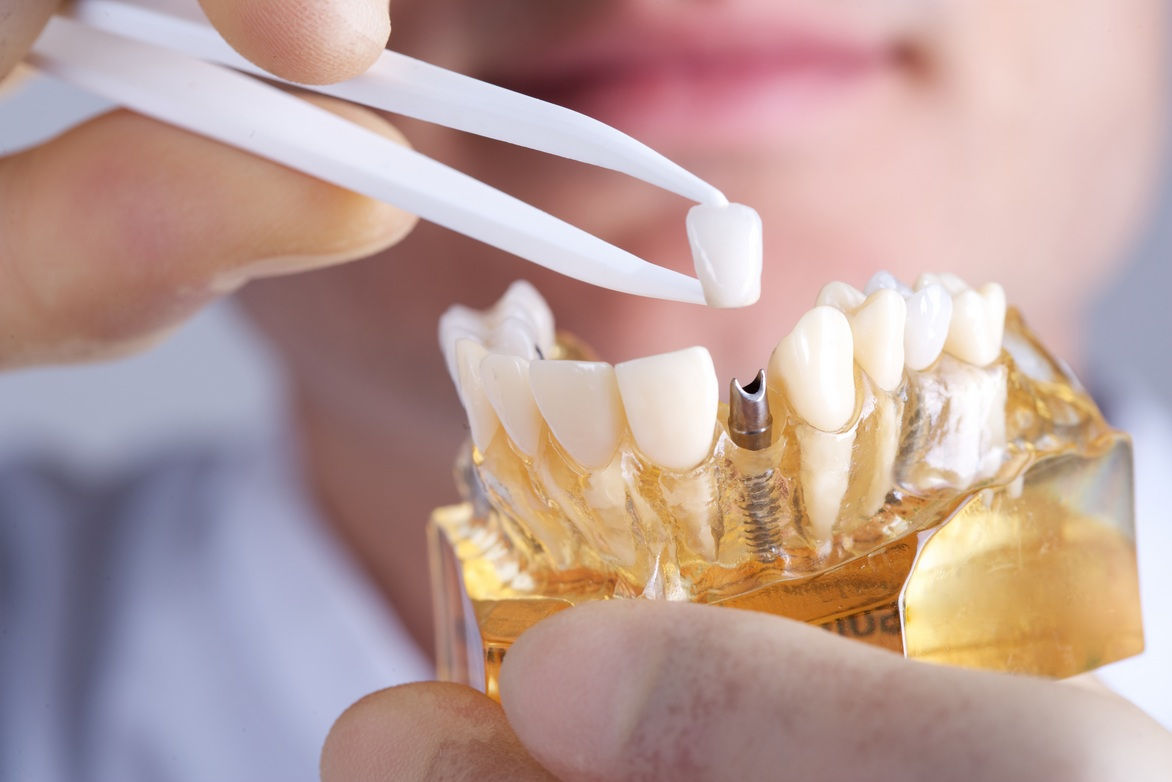 dental implants in Yellowknife