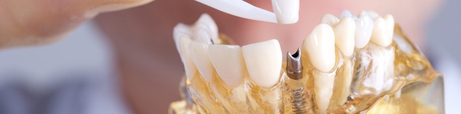 why am I so tired after receiving dental Implants