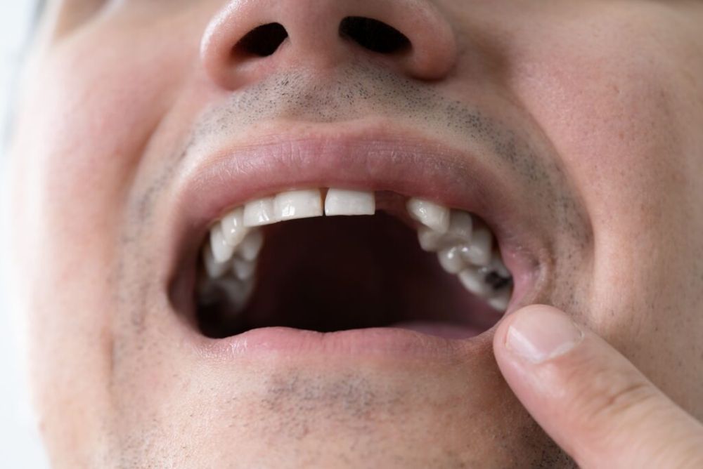 How to Take Care of Your Mouth After a Tooth Extraction