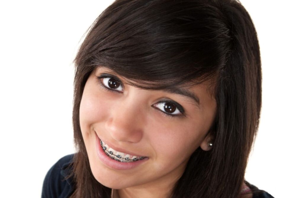 Traditional Braces and Their Benefits
