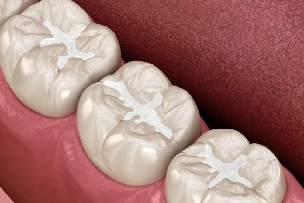 Revive Your Teeth’s Health with Composite Fillings