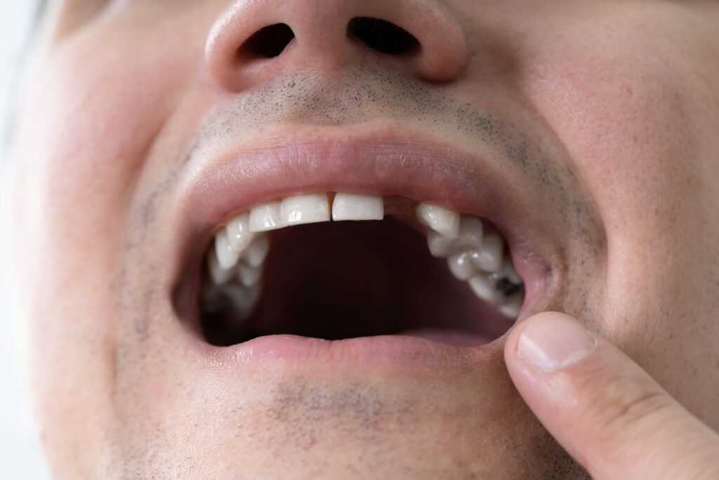 how to take care of your mouth after a tooth extraction