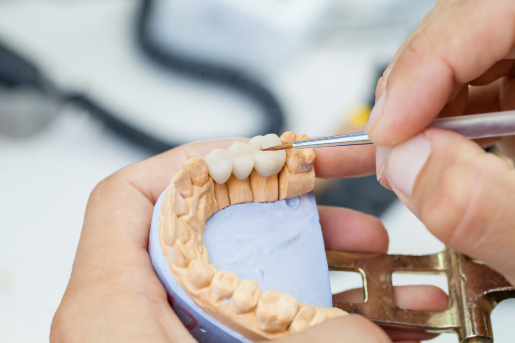 why consider a dental bridge for your oral health