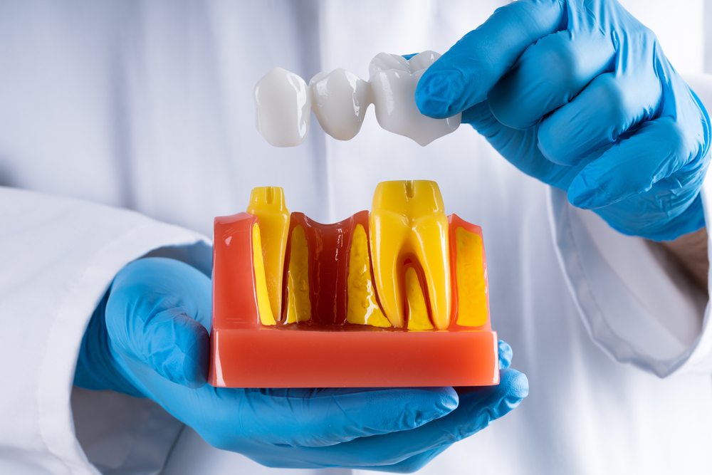 3 reasons why dental bridges are your ideal tooth replacement treatment