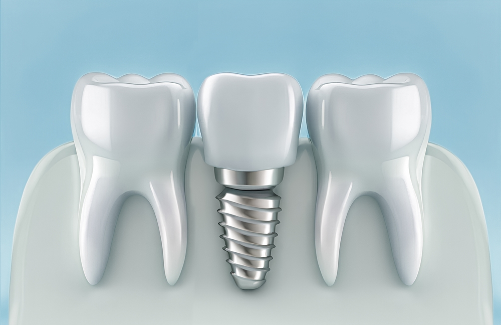 dental implants benefits procedure and aftercare