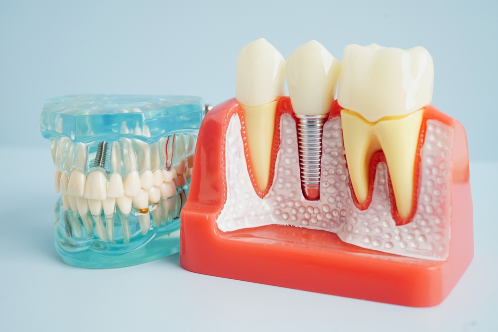 why dental implants outlast dentures