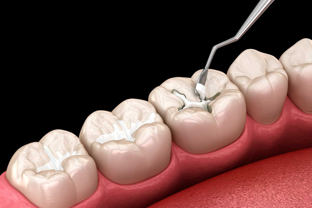 Repair cavities with composite fillings in Yellowknife for a durable, invisible solution that preserves your smile’s natural beauty