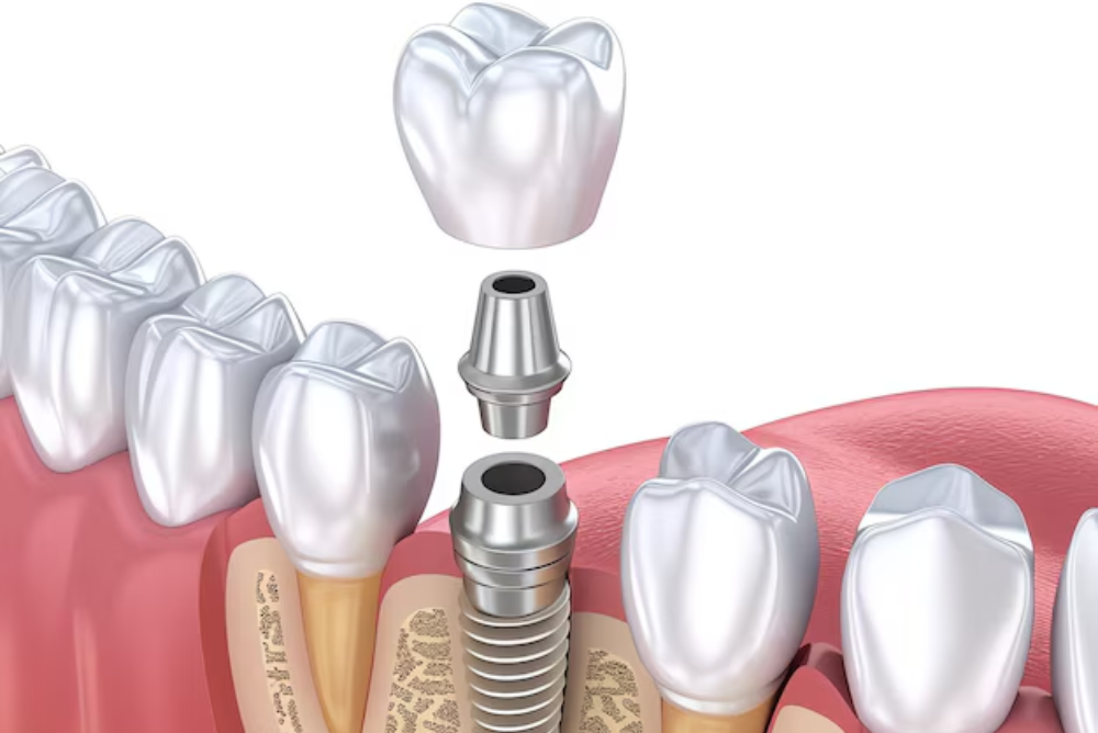 Looking for dental implants in Yellowknife? We provide strong, natural-looking dental implants near you to restore your smile and confidence. Book today.