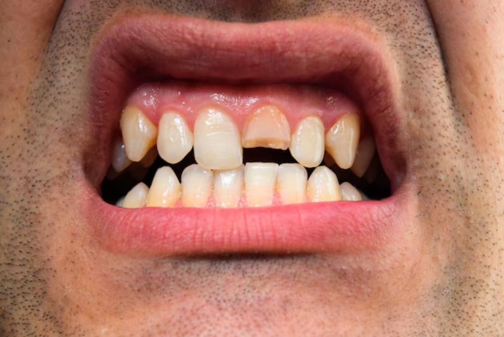 How Do You Handle a Knocked-Out or Broken Tooth?